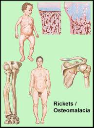 osteomalacia