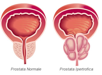 Stadiazione-Tumore-alla-Prostata