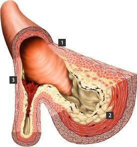 arterie