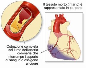 infarto-del-miocardio
