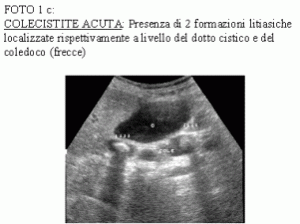 coleciste
