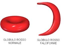 anemia-falciforme