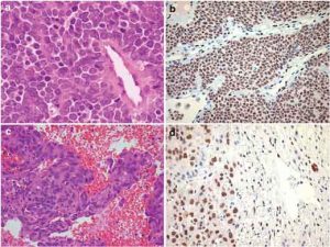 sarcoma-di-ewing