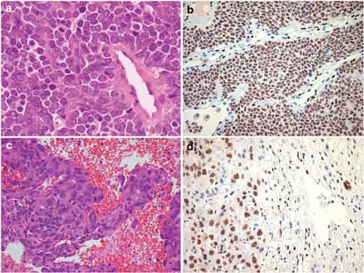 sarcoma-di-ewing
