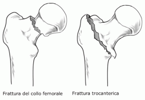 anca-femore