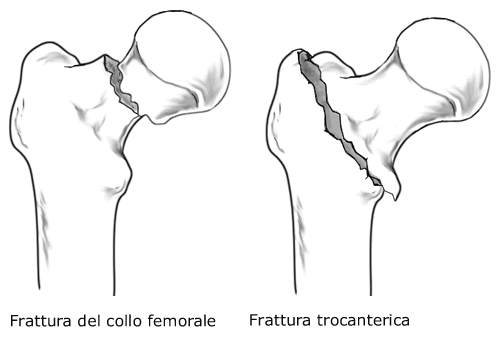 anca-femore