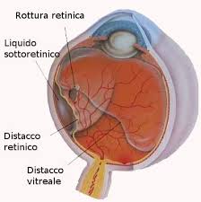 distacco-retina