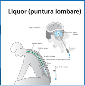 liquor-rachicentesi