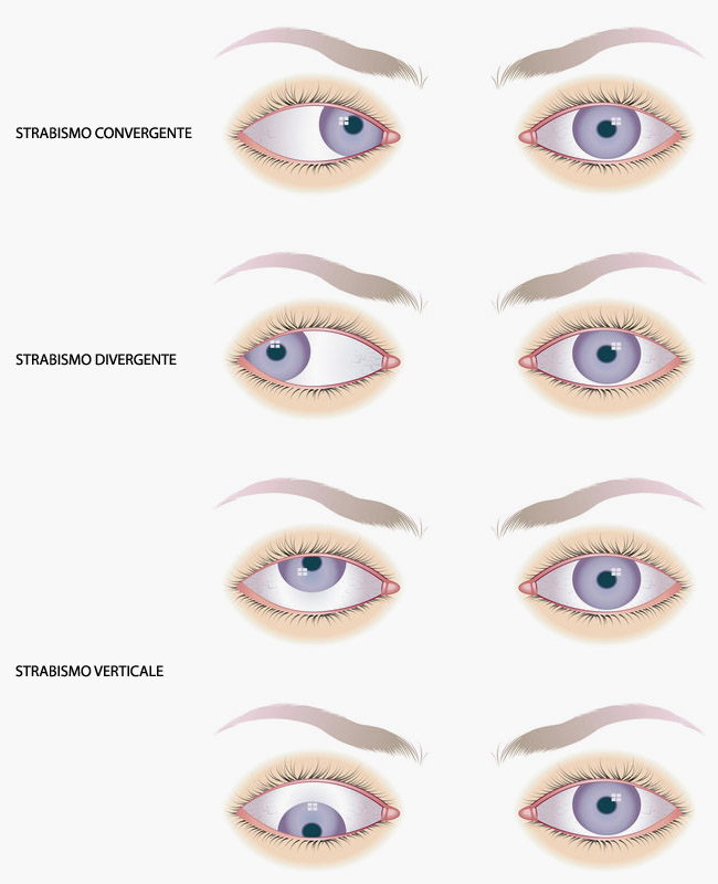 strabismo