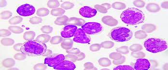 leucemia -acuta