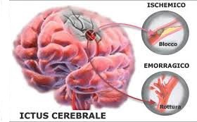 ictus-cerebrale