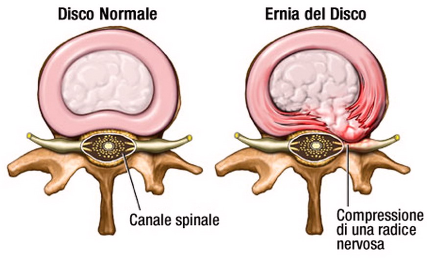 ernia_disco